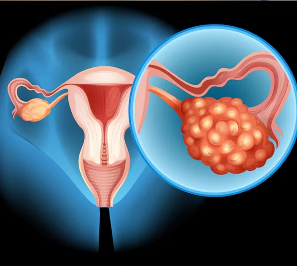 Uterine Fibroids