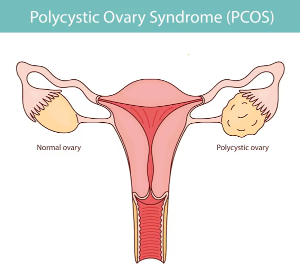 PCOD or PCOS