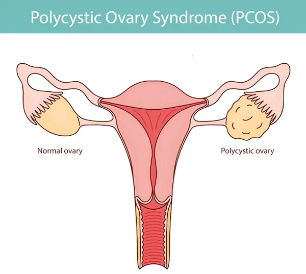 PCOD or PCOS