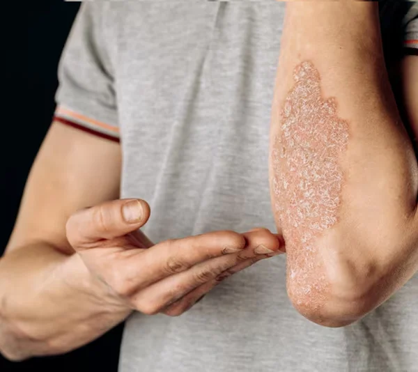 Psoriasis