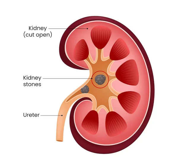 Kidney Stones